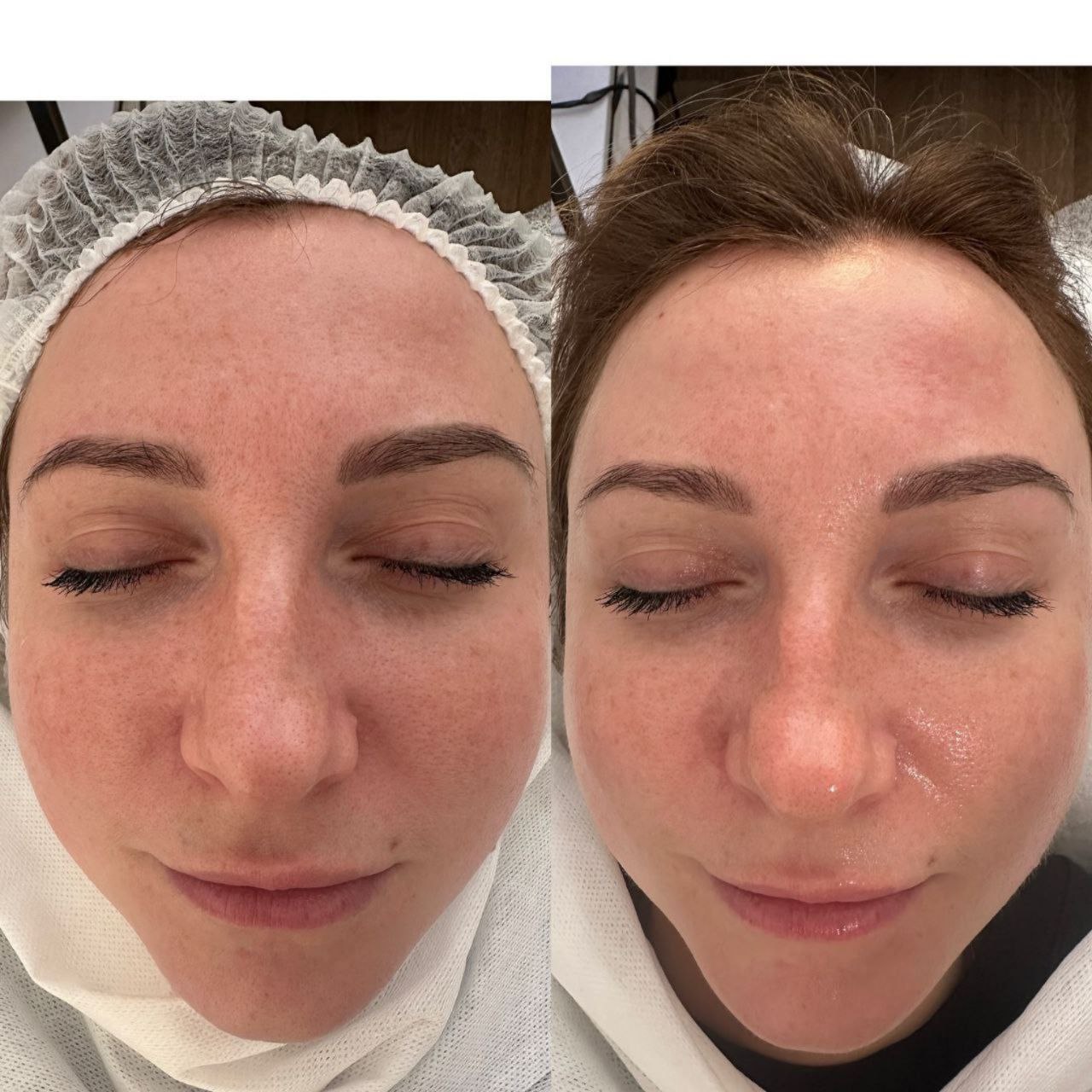 Пример практического применения авторского протокола Intensive Peptide Anti-Age Therapy — Фото № 1