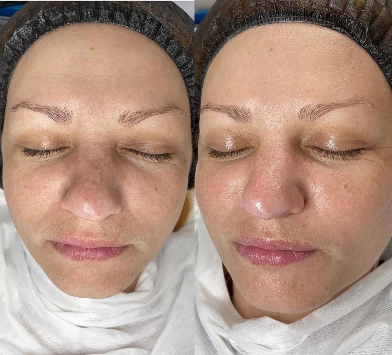 Пример практического применения авторского Skin Brightening — Фото № 10