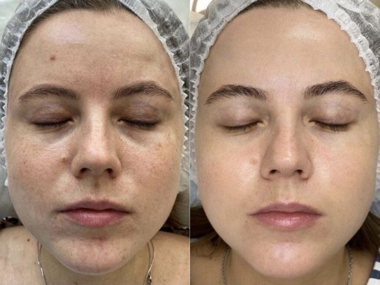 Пример практического применения авторского Skin Brightening — Фото № 7
